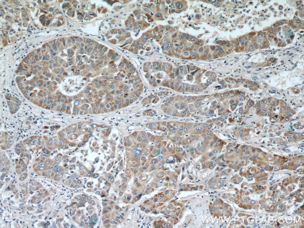 Immunohistochemistry (IHC) staining of human liver cancer tissue using DBH Polyclonal antibody (10777-1-AP)