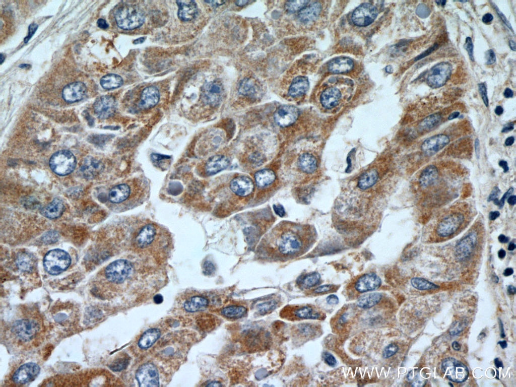 Immunohistochemistry (IHC) staining of human liver cancer tissue using DBH Polyclonal antibody (10777-1-AP)