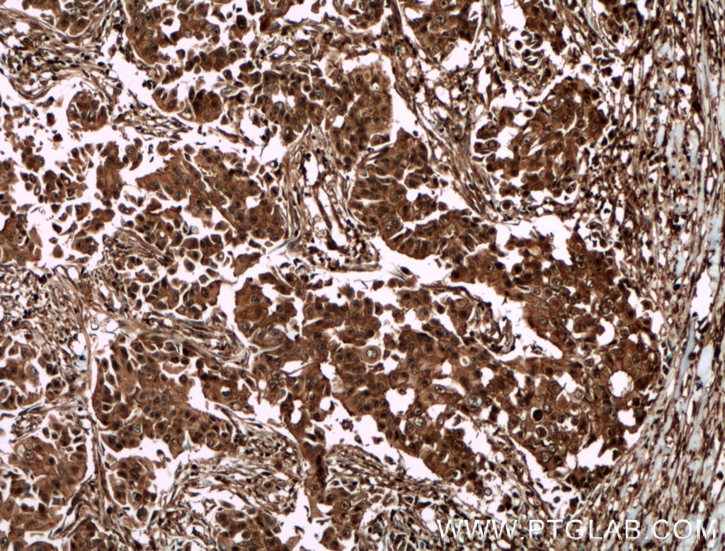 Immunohistochemistry (IHC) staining of human breast cancer tissue using HIP55 Polyclonal antibody (13015-1-AP)