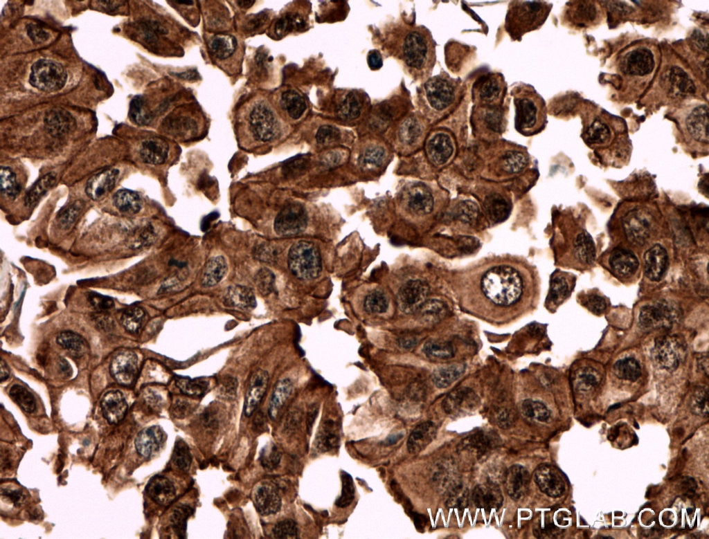 Immunohistochemistry (IHC) staining of human breast cancer tissue using HIP55 Polyclonal antibody (13015-1-AP)