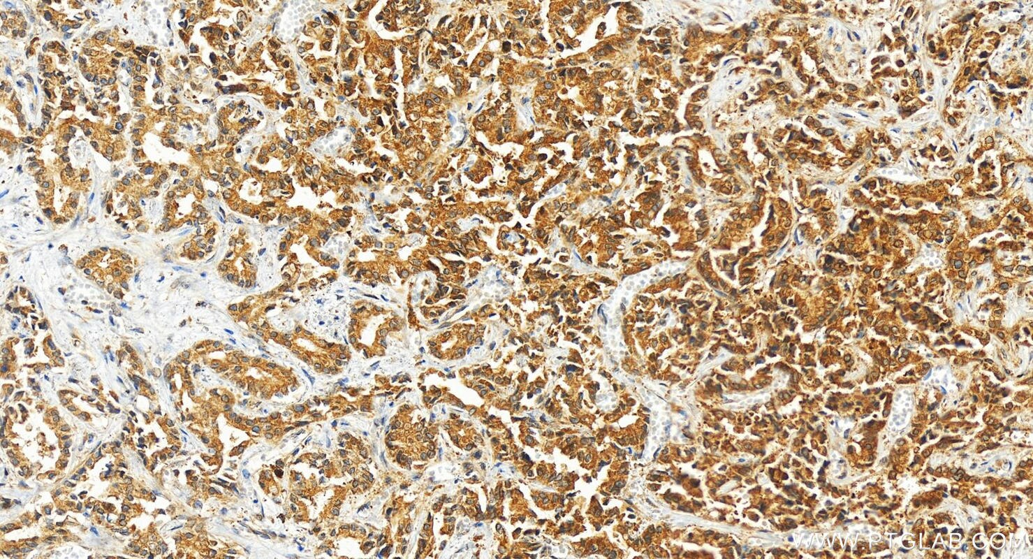 Immunohistochemistry (IHC) staining of human intrahepatic cholangiocarcinoma tissue using DCBLD2 Polyclonal antibody (13168-1-AP)