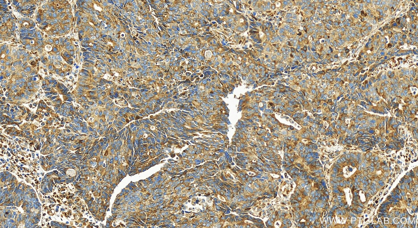 Immunohistochemistry (IHC) staining of human stomach cancer tissue using DCBLD2 Polyclonal antibody (30245-1-AP)