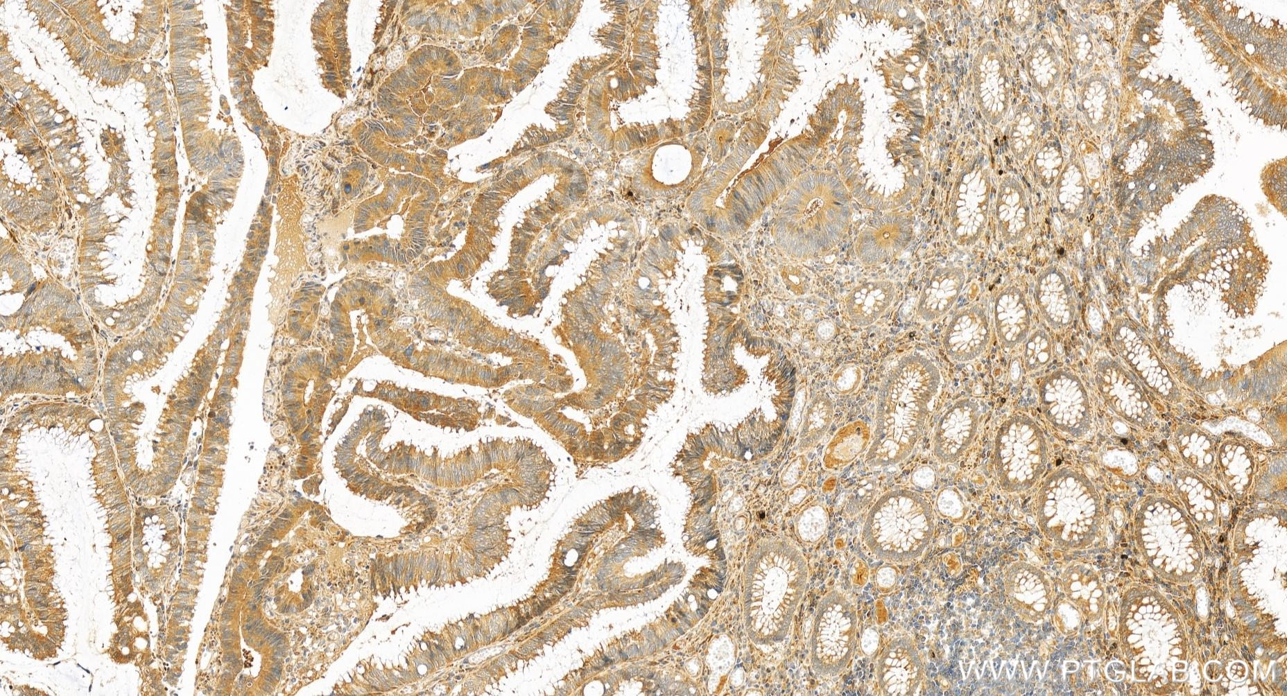 Immunohistochemistry (IHC) staining of human colon cancer tissue using DCBLD2 Recombinant antibody (85000-4-RR)