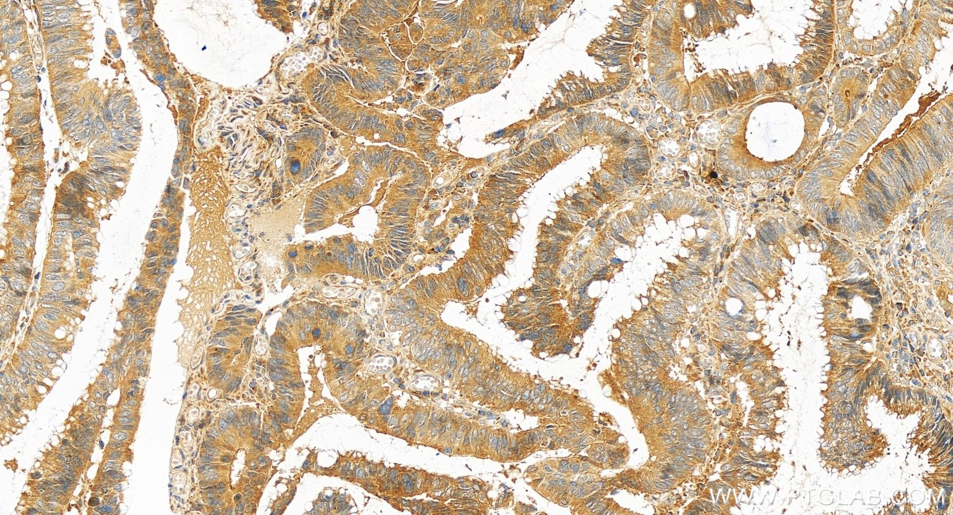 Immunohistochemistry (IHC) staining of human colon cancer tissue using DCBLD2 Recombinant antibody (85000-4-RR)