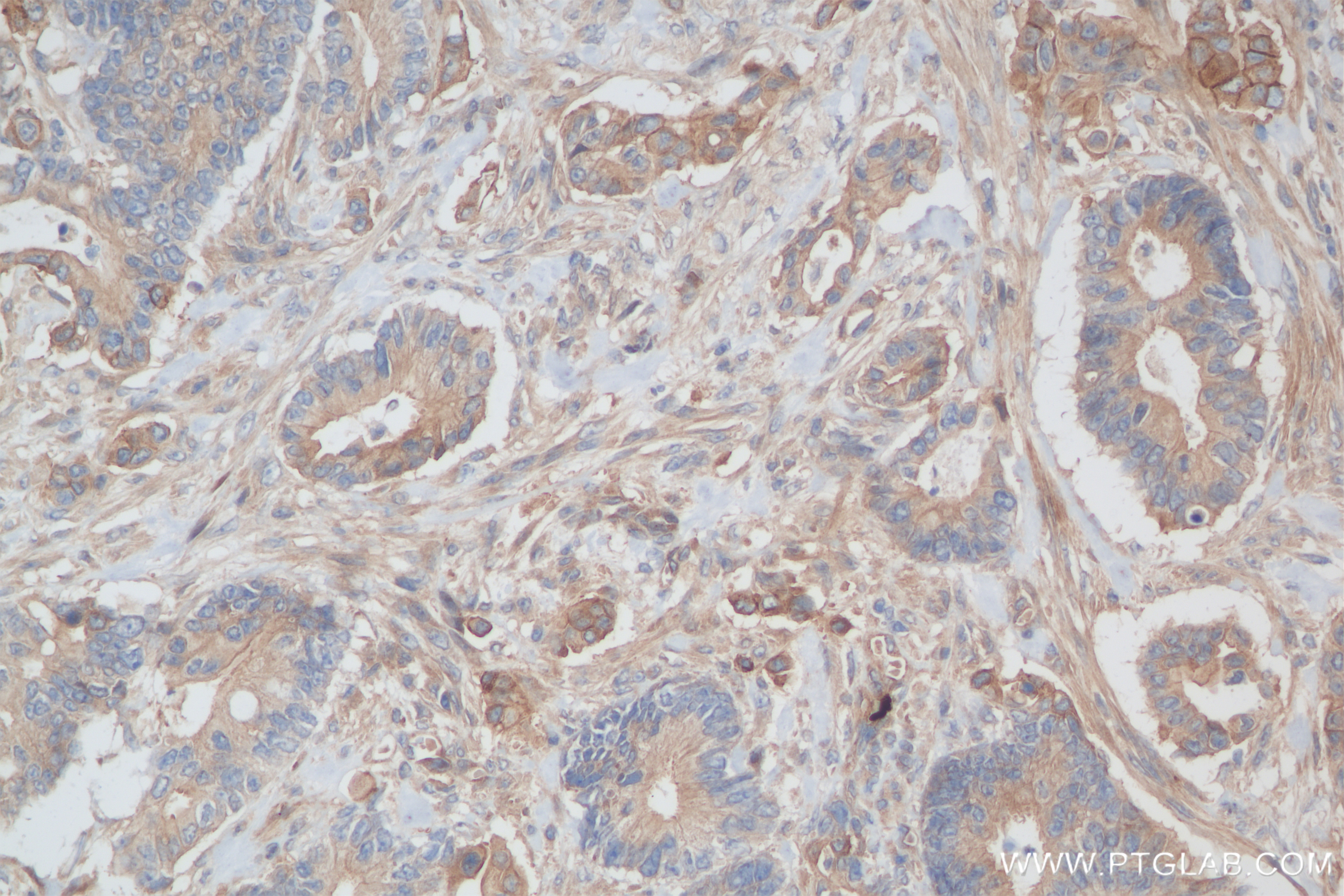 Immunohistochemistry (IHC) staining of human rectal cancer tissue using DCBLD2 Recombinant antibody (85000-4-RR)
