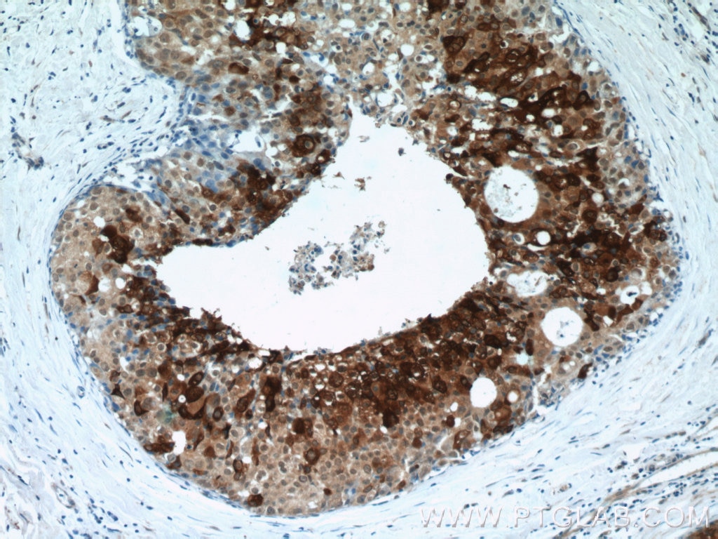 Immunohistochemistry (IHC) staining of human breast cancer tissue using DCD Polyclonal antibody (11985-1-AP)