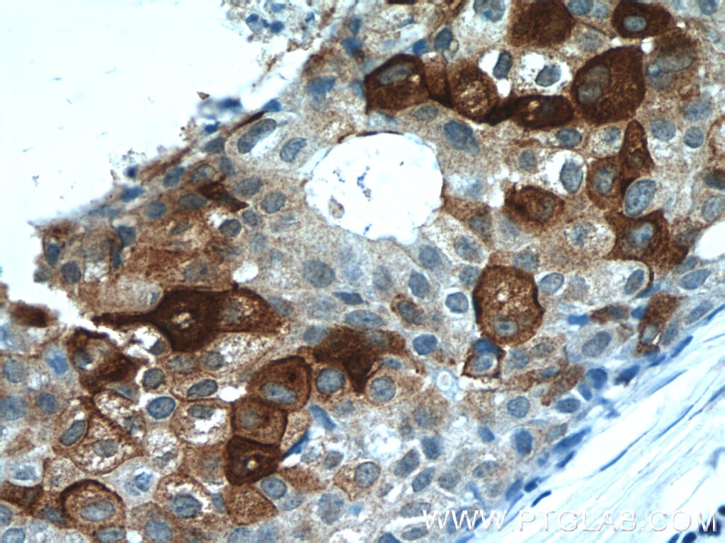 Immunohistochemistry (IHC) staining of human breast cancer tissue using DCD Polyclonal antibody (11985-1-AP)