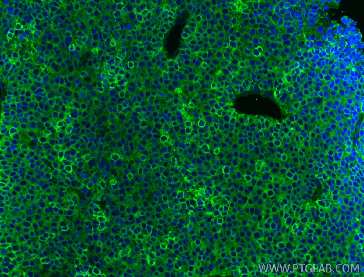 Immunofluorescent analysis of (4% PFA) fixed paraffin-embedded human liver cancer tissue using DCDC2 antibody (26978-1-AP) at dilution of 1:200 and CoraLite®488-Conjugated Goat Anti-Rabbit IgG(H+L) (SA00013-2). Heat mediated antigen retrieval with Tris-EDTA buffer (pH 9.0). Immunofluorescence (IF) / fluorescent staining of human liver cancer tissue using DCDC2 Polyclonal antibody (26978-1-AP)