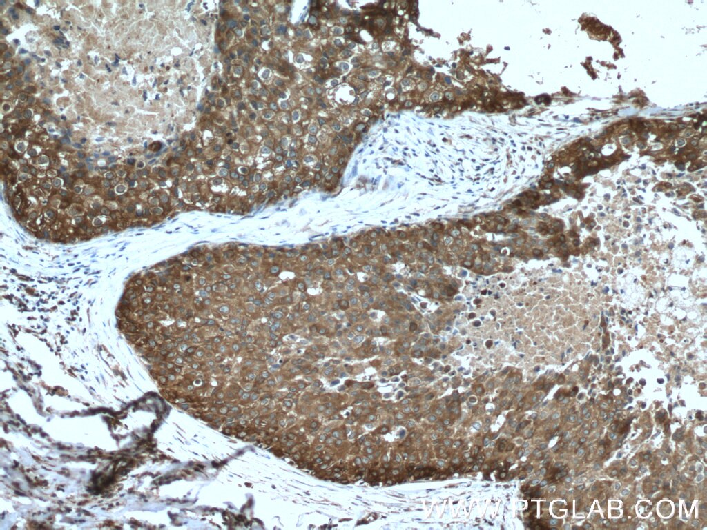 Immunohistochemistry (IHC) staining of human breast cancer tissue using DCDC2 Polyclonal antibody (26978-1-AP)