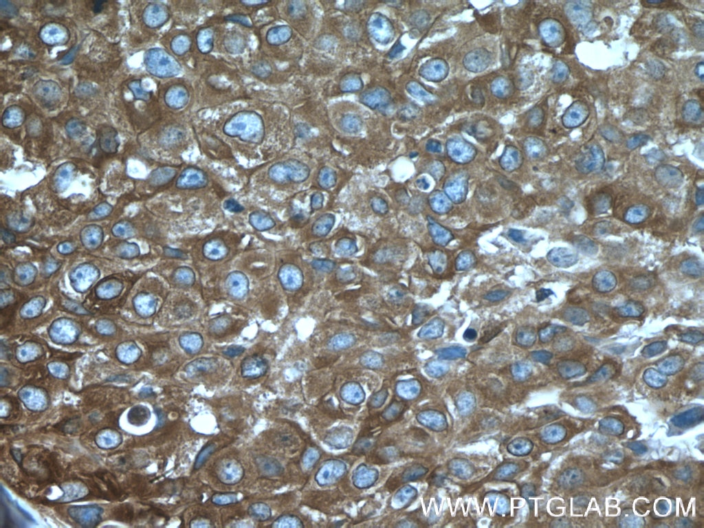Immunohistochemistry (IHC) staining of human breast cancer tissue using DCDC2 Polyclonal antibody (26978-1-AP)