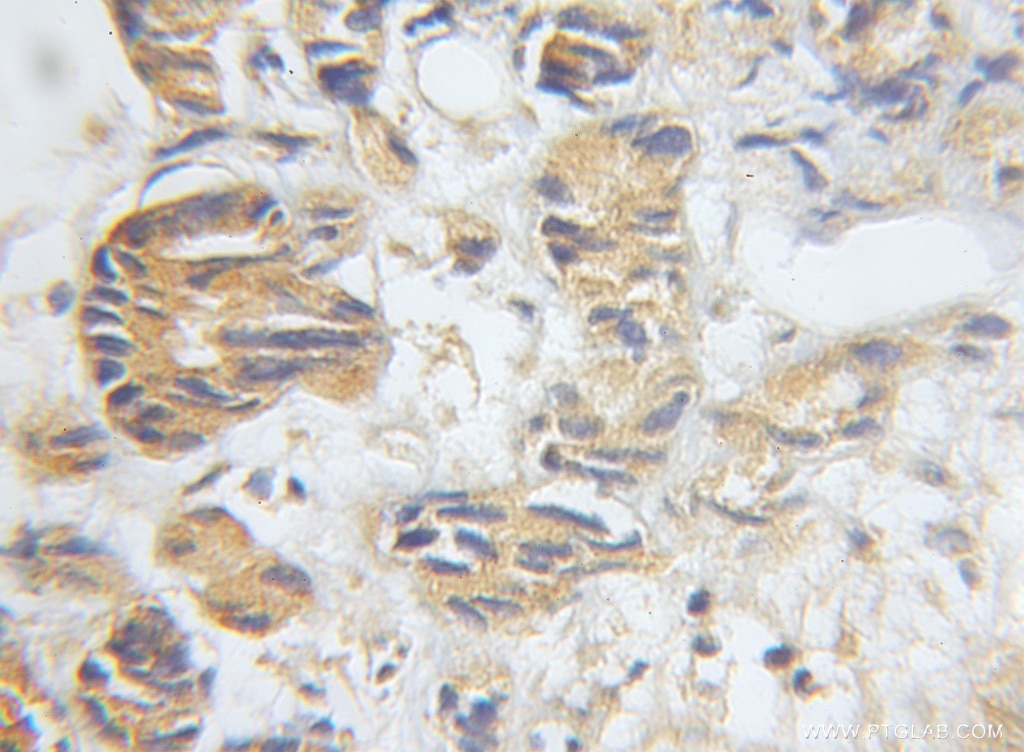 Immunohistochemistry (IHC) staining of human prostate cancer tissue using DCI Polyclonal antibody (11535-1-AP)