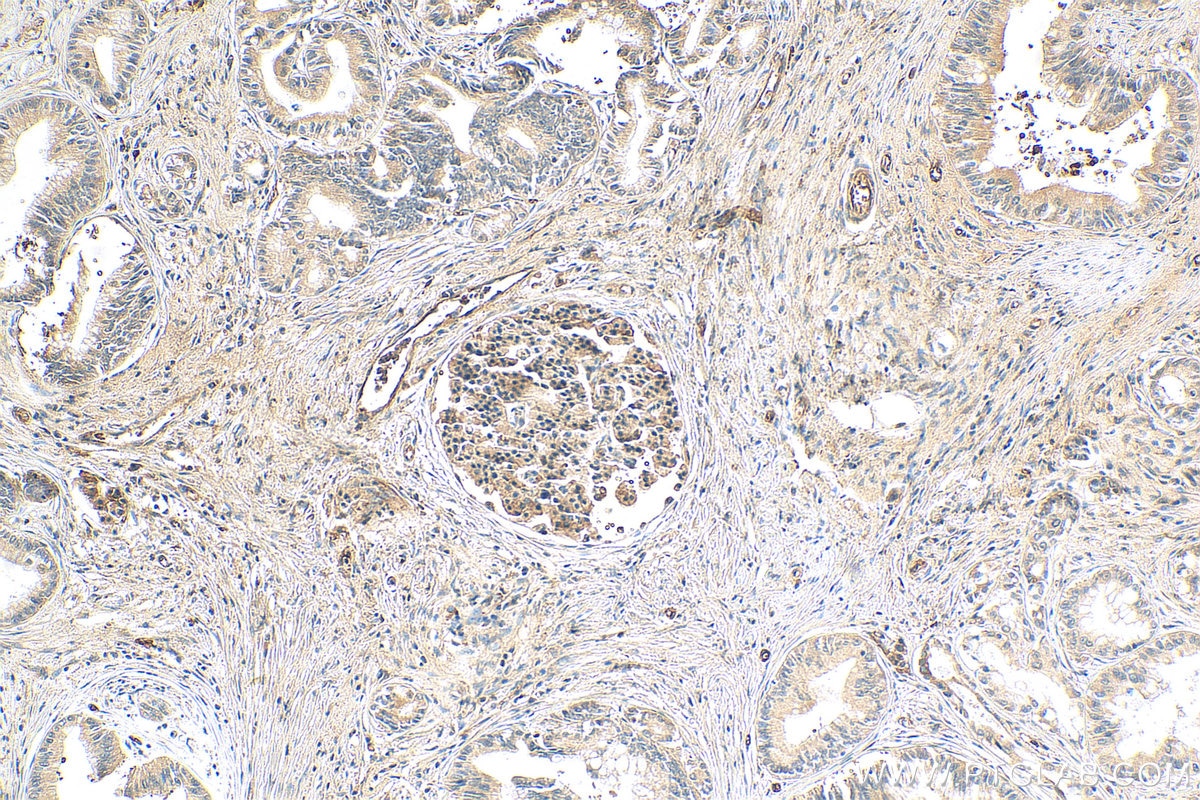 Immunohistochemistry (IHC) staining of human pancreas cancer tissue using DCLK1 Polyclonal antibody (21699-1-AP)