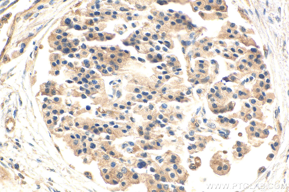 Immunohistochemistry (IHC) staining of human pancreas cancer tissue using DCLK1 Polyclonal antibody (21699-1-AP)