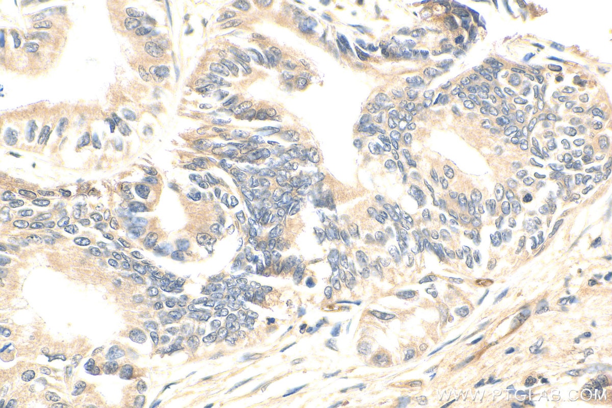 Immunohistochemistry (IHC) staining of human pancreas cancer tissue using DCLK1 Polyclonal antibody (21699-1-AP)