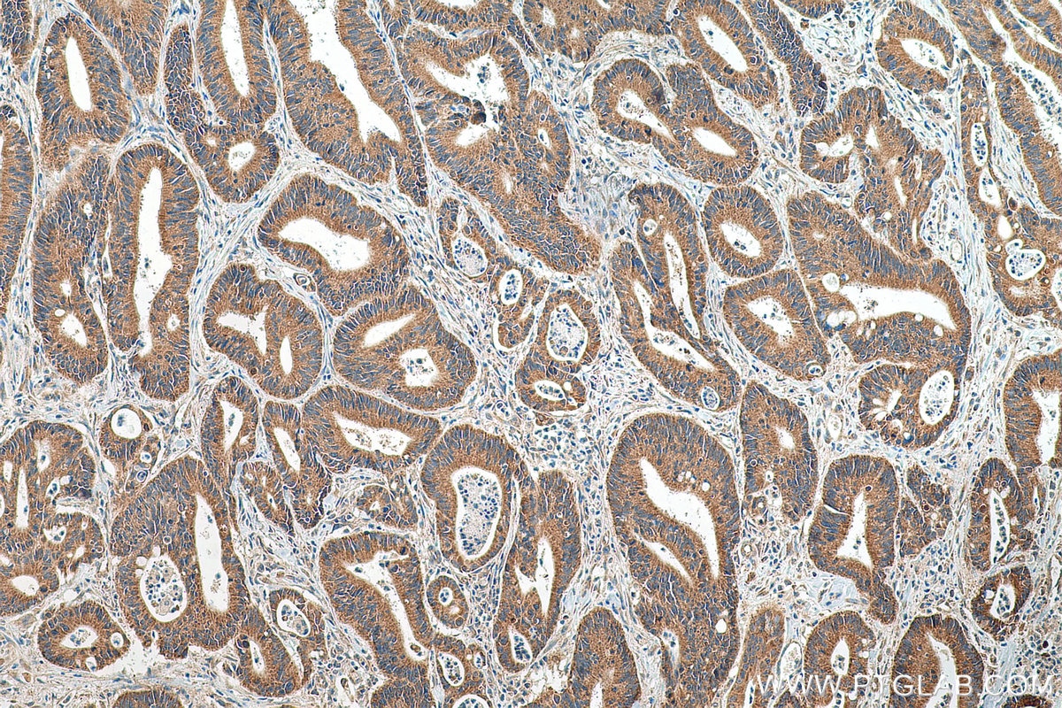 Immunohistochemistry (IHC) staining of human colon cancer tissue using DCLK1 Polyclonal antibody (29800-1-AP)