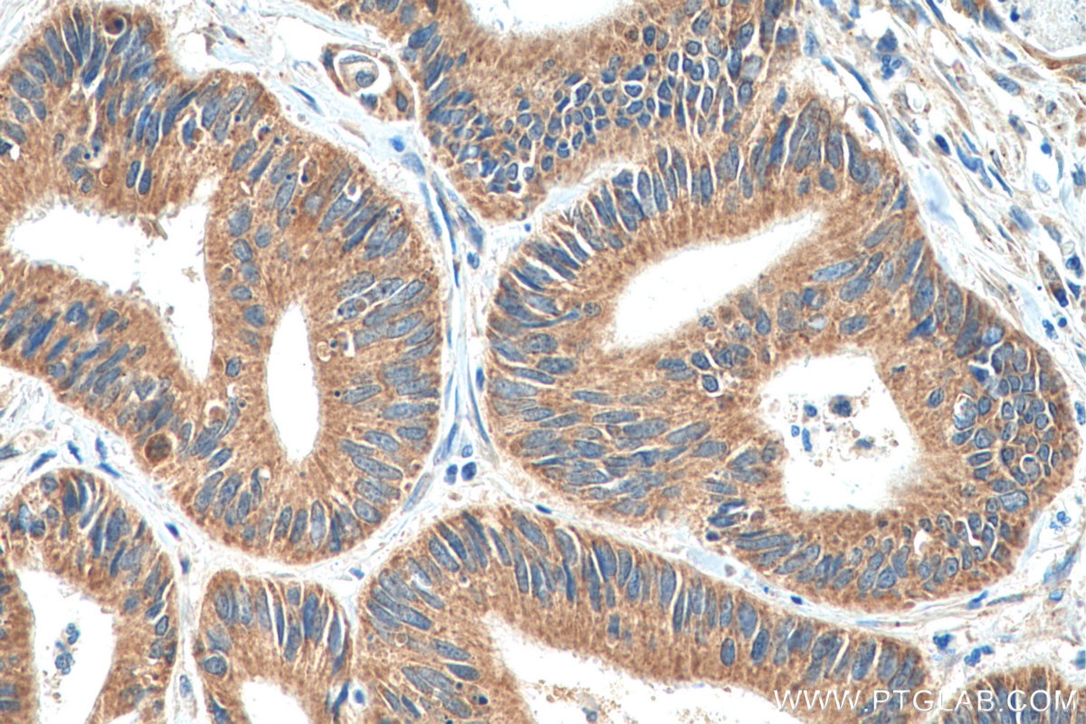 Immunohistochemistry (IHC) staining of human colon cancer tissue using DCLK1 Polyclonal antibody (29800-1-AP)