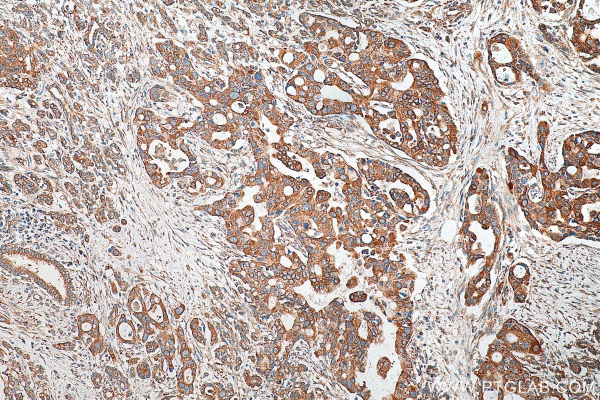 Immunohistochemistry (IHC) staining of human pancreas cancer tissue using DCLK1 Polyclonal antibody (29800-1-AP)