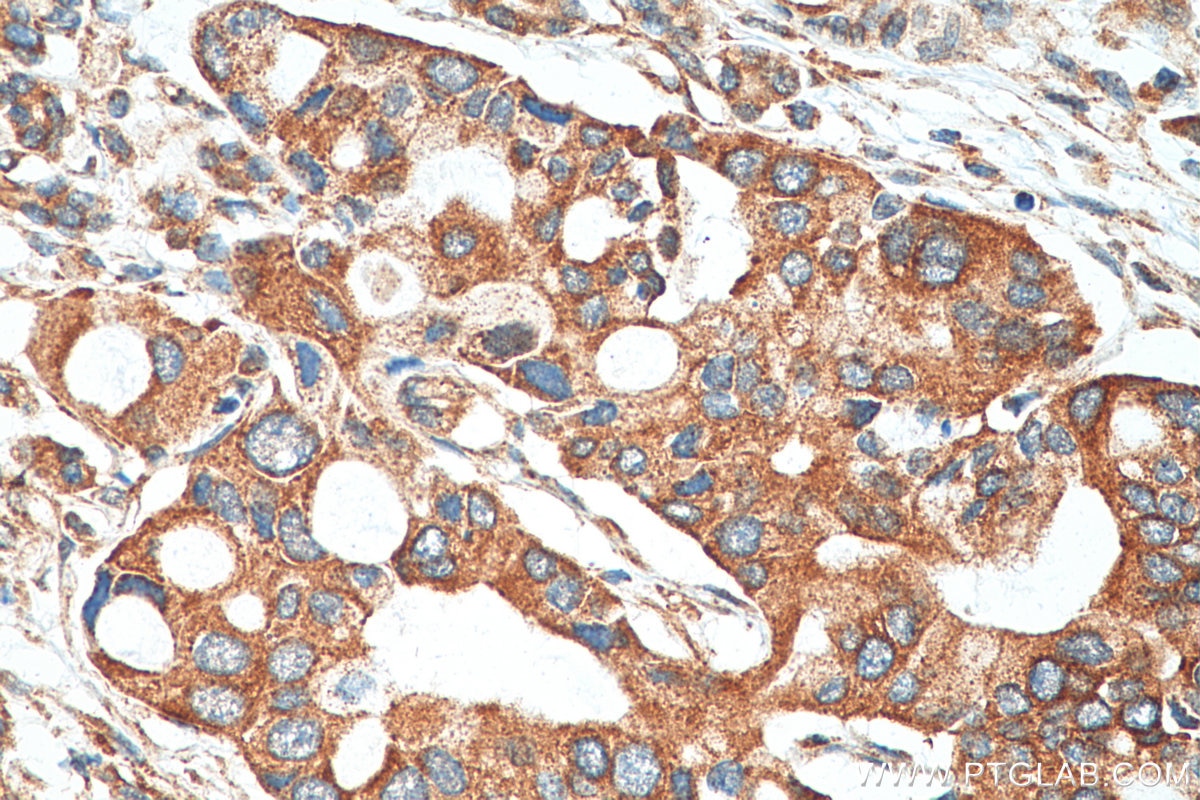 Immunohistochemistry (IHC) staining of human pancreas cancer tissue using DCLK1 Polyclonal antibody (29800-1-AP)