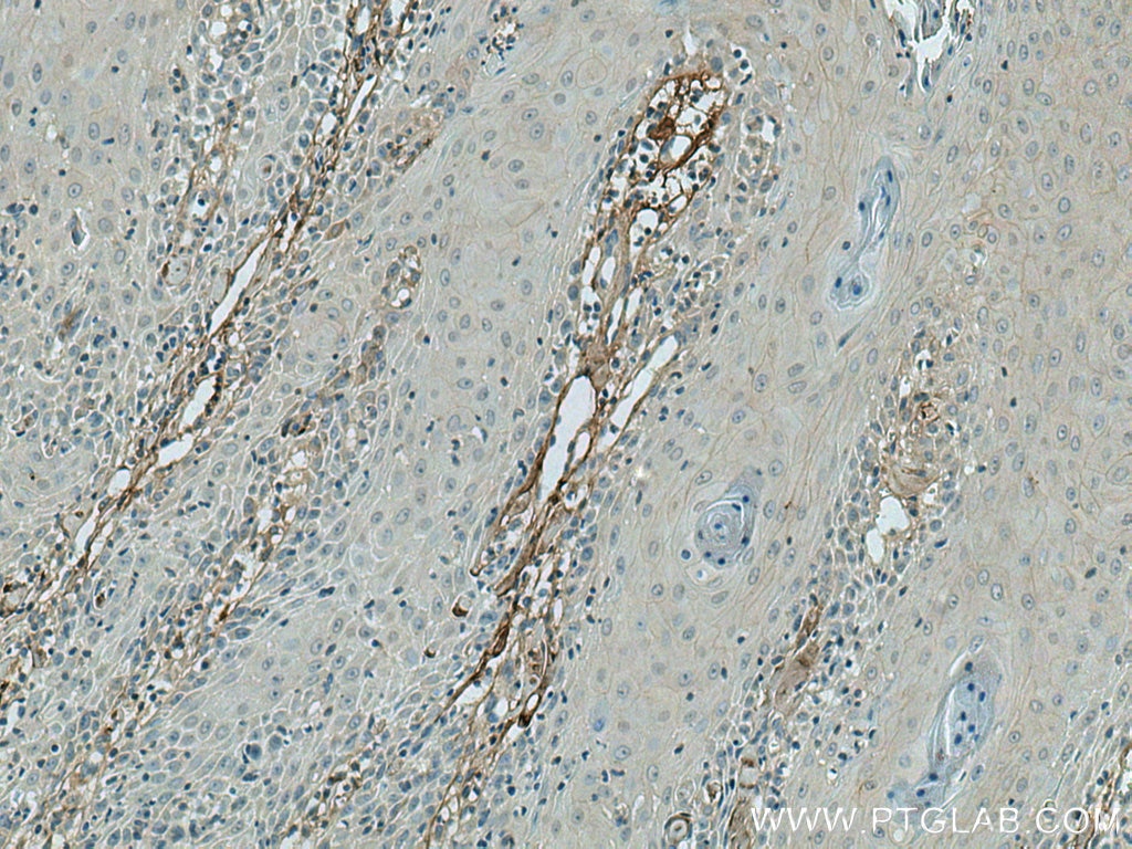 Immunohistochemistry (IHC) staining of human skin cancer tissue using Decorin Polyclonal antibody (14667-1-AP)