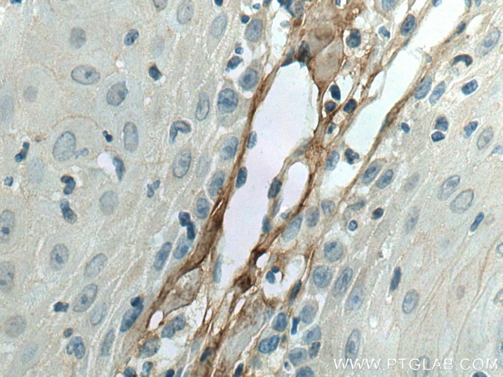 Immunohistochemistry (IHC) staining of human skin cancer tissue using Decorin Polyclonal antibody (14667-1-AP)