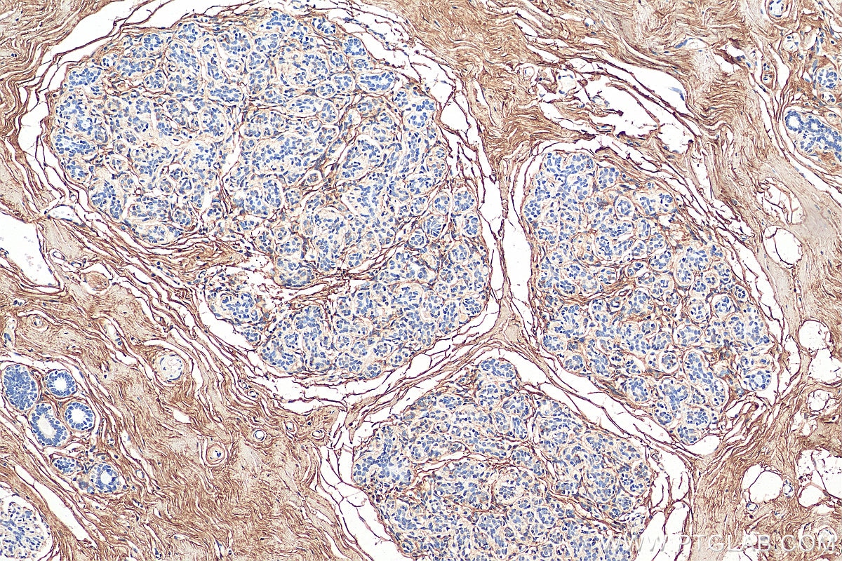 IHC staining of human breast cancer using 14667-1-AP
