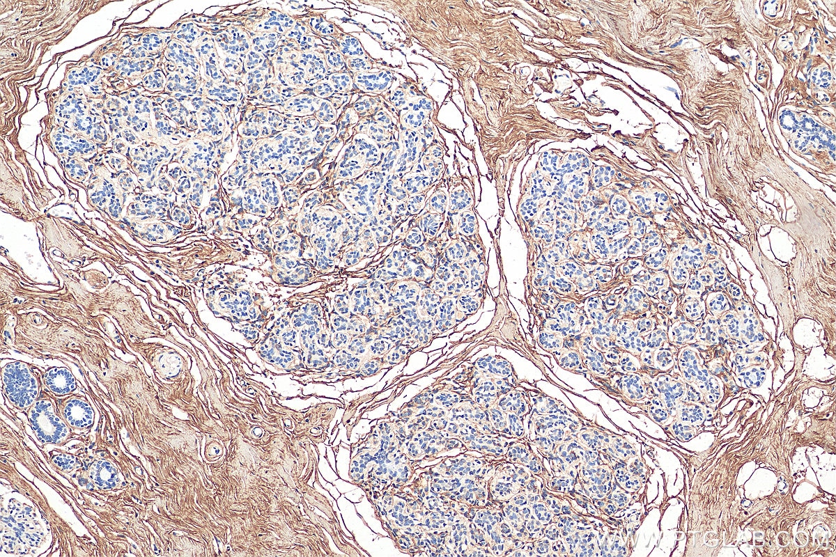 Immunohistochemistry (IHC) staining of human breast cancer tissue using Decorin Polyclonal antibody (14667-1-AP)