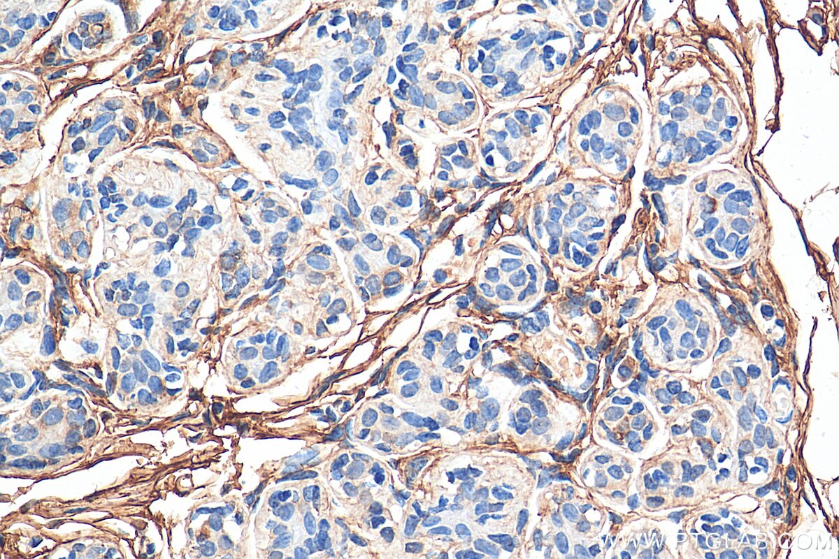 Immunohistochemistry (IHC) staining of human breast cancer tissue using Decorin Polyclonal antibody (14667-1-AP)