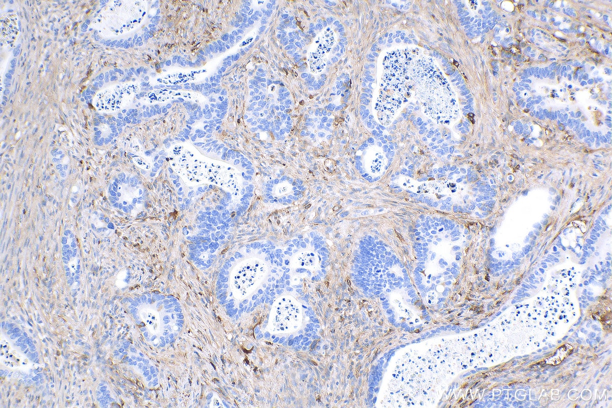 Immunohistochemistry (IHC) staining of human colon cancer tissue using Decorin Polyclonal antibody (14667-1-AP)