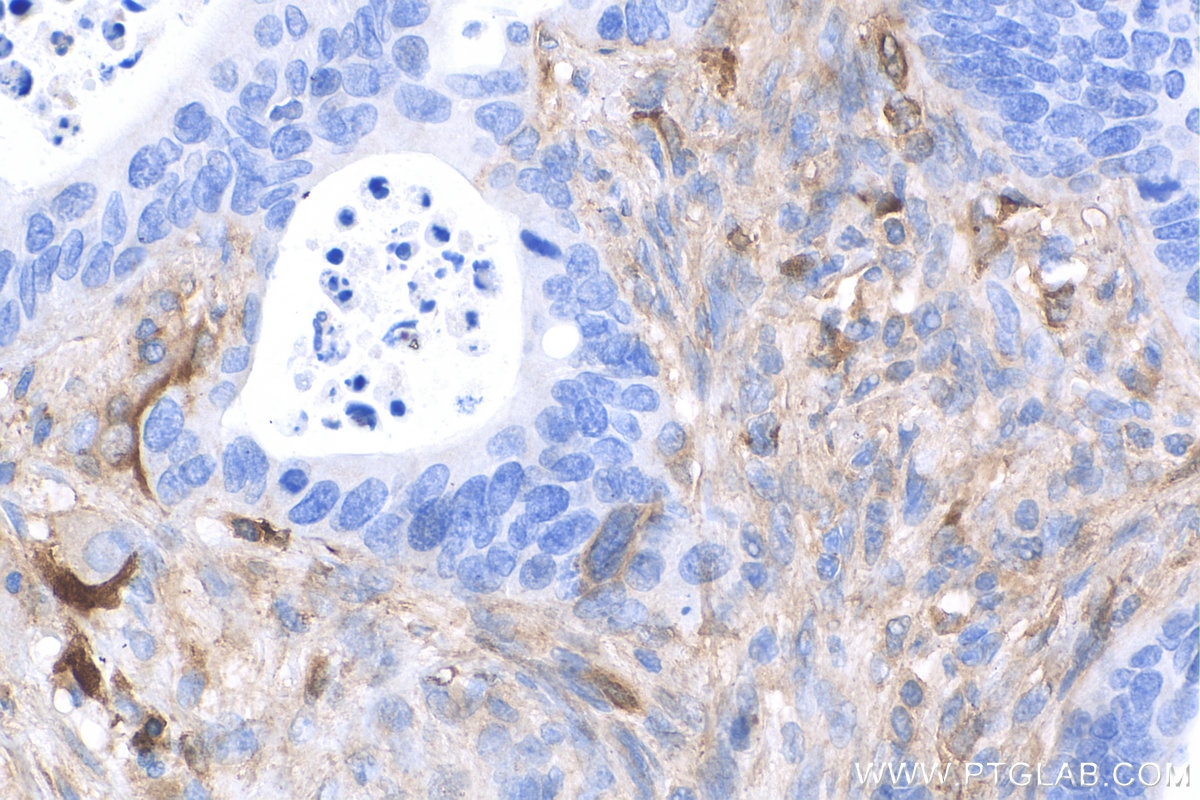 Immunohistochemistry (IHC) staining of human colon cancer tissue using Decorin Polyclonal antibody (14667-1-AP)