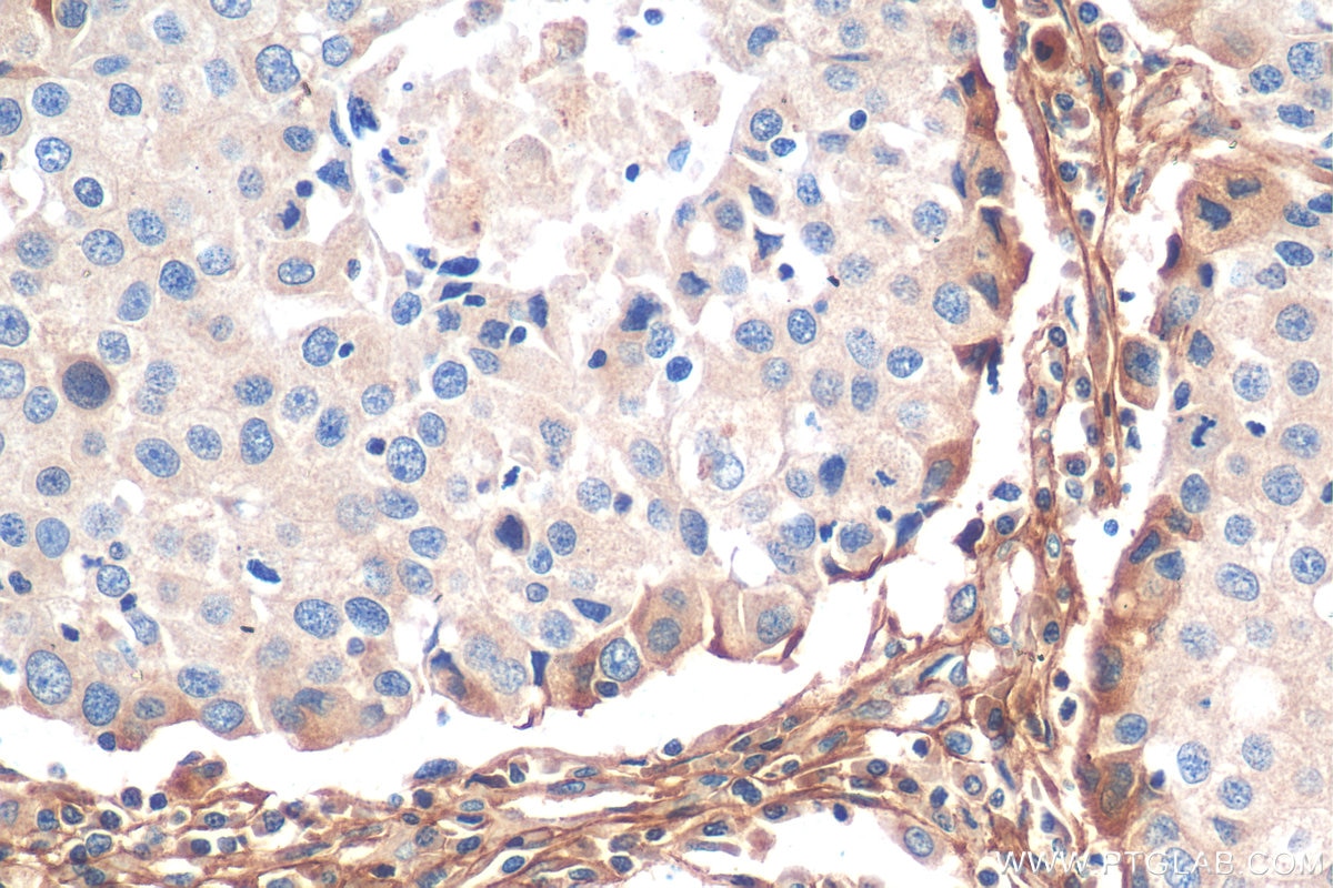 Immunohistochemistry (IHC) staining of human breast cancer tissue using Decorin Polyclonal antibody (14667-1-AP)