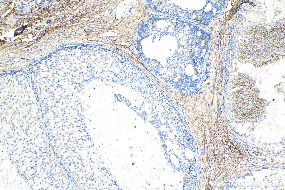 Immunohistochemistry (IHC) staining of human breast hyperplasia tissue using Decorin Polyclonal antibody (14667-1-AP)