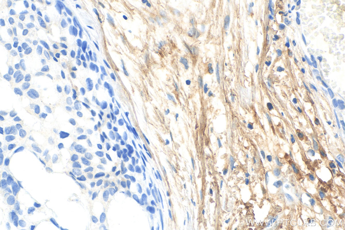 Immunohistochemistry (IHC) staining of human breast hyperplasia tissue using Decorin Polyclonal antibody (14667-1-AP)