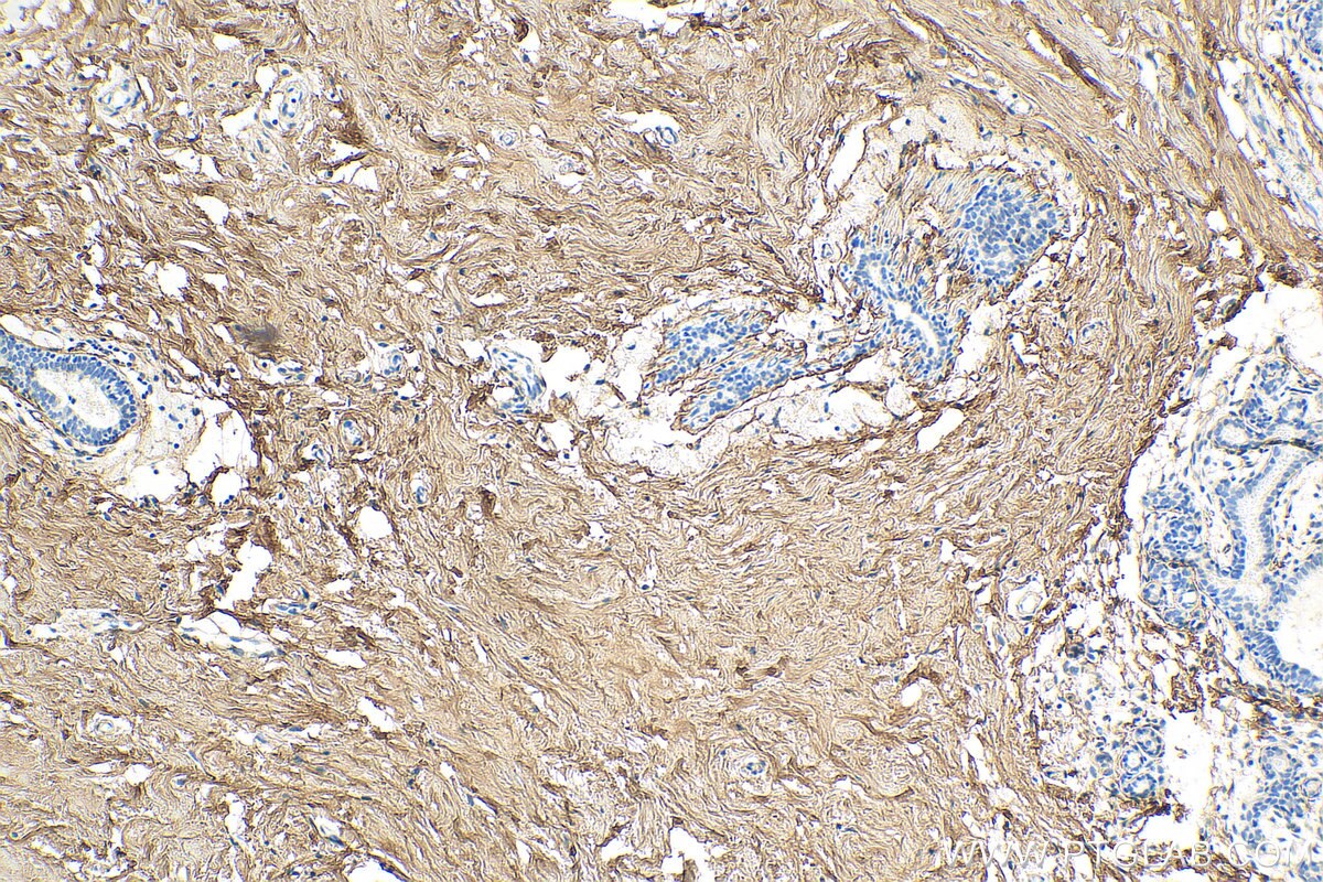 Immunohistochemistry (IHC) staining of human breast hyperplasia tissue using Decorin Polyclonal antibody (14667-1-AP)