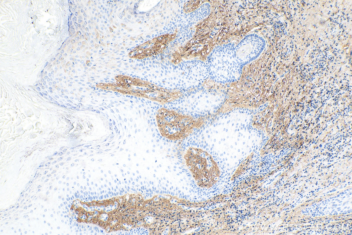 Immunohistochemistry (IHC) staining of human skin cancer tissue using Decorin Polyclonal antibody (14667-1-AP)