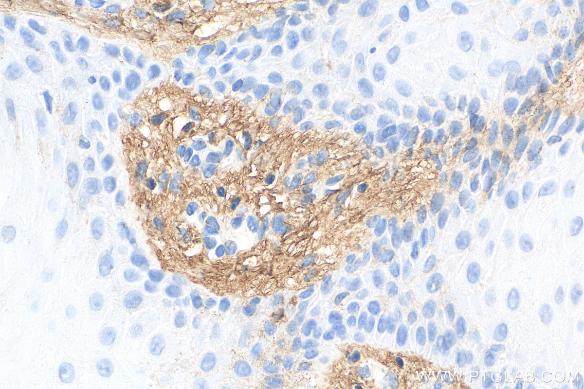 IHC staining of human skin cancer using 14667-1-AP
