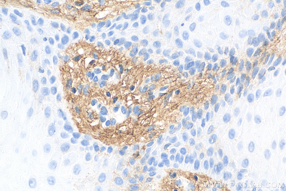 Immunohistochemistry (IHC) staining of human skin cancer tissue using Decorin Polyclonal antibody (14667-1-AP)