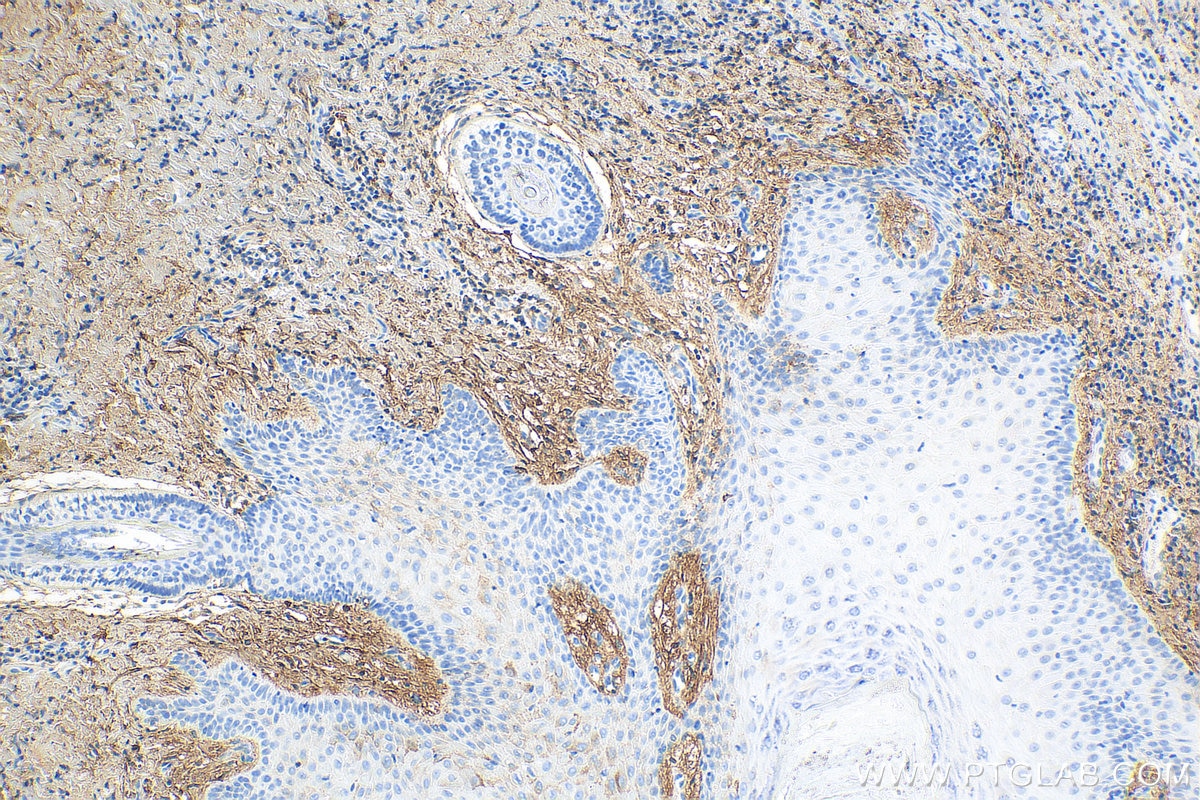Immunohistochemistry (IHC) staining of human skin cancer tissue using Decorin Polyclonal antibody (14667-1-AP)