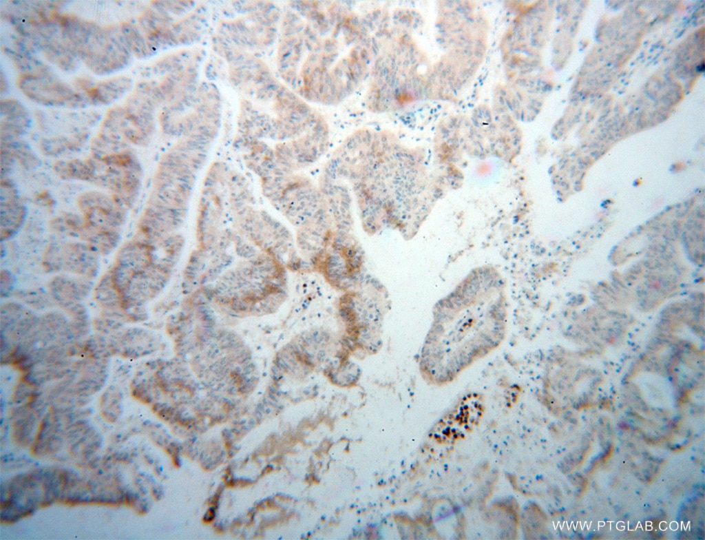 Immunohistochemistry (IHC) staining of human liver cancer tissue using DCP1B Polyclonal antibody (13863-1-AP)