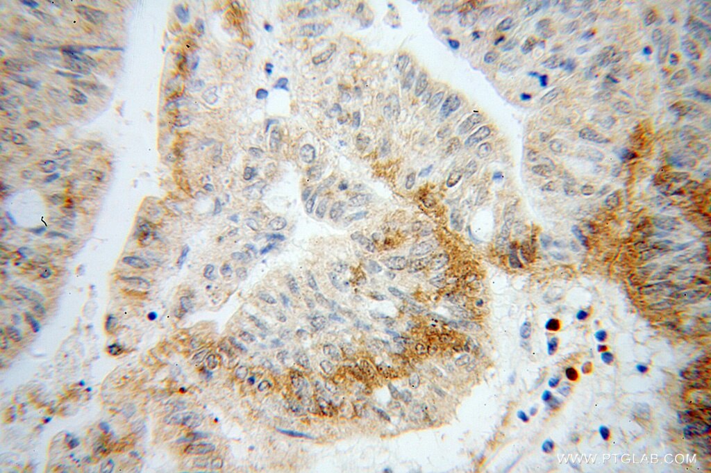 Immunohistochemistry (IHC) staining of human liver cancer tissue using DCP1B Polyclonal antibody (13863-1-AP)