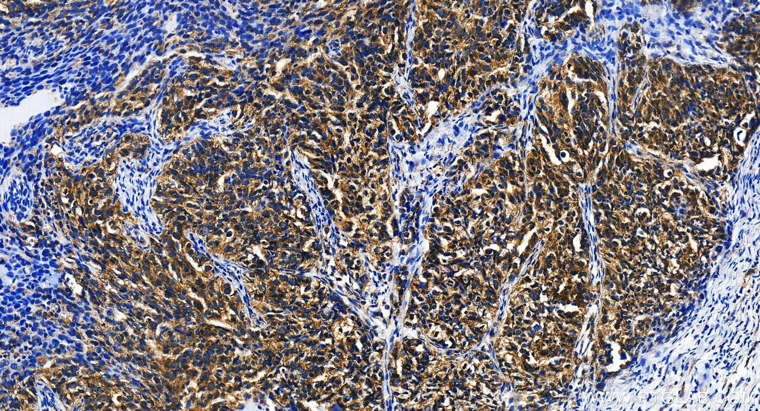 Immunohistochemistry (IHC) staining of human ovary cancer tissue using DCP2 Polyclonal antibody (17744-1-AP)