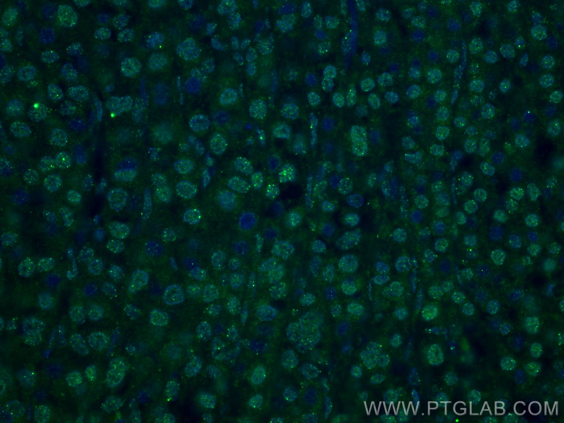 Immunofluorescence (IF) / fluorescent staining of human liver cancer tissue using DCPS Monoclonal antibody (67311-1-Ig)
