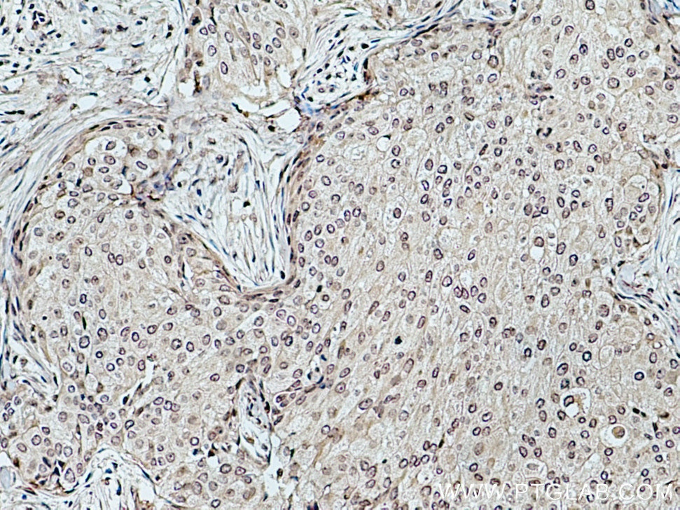 IHC staining of human breast cancer using 67311-1-Ig