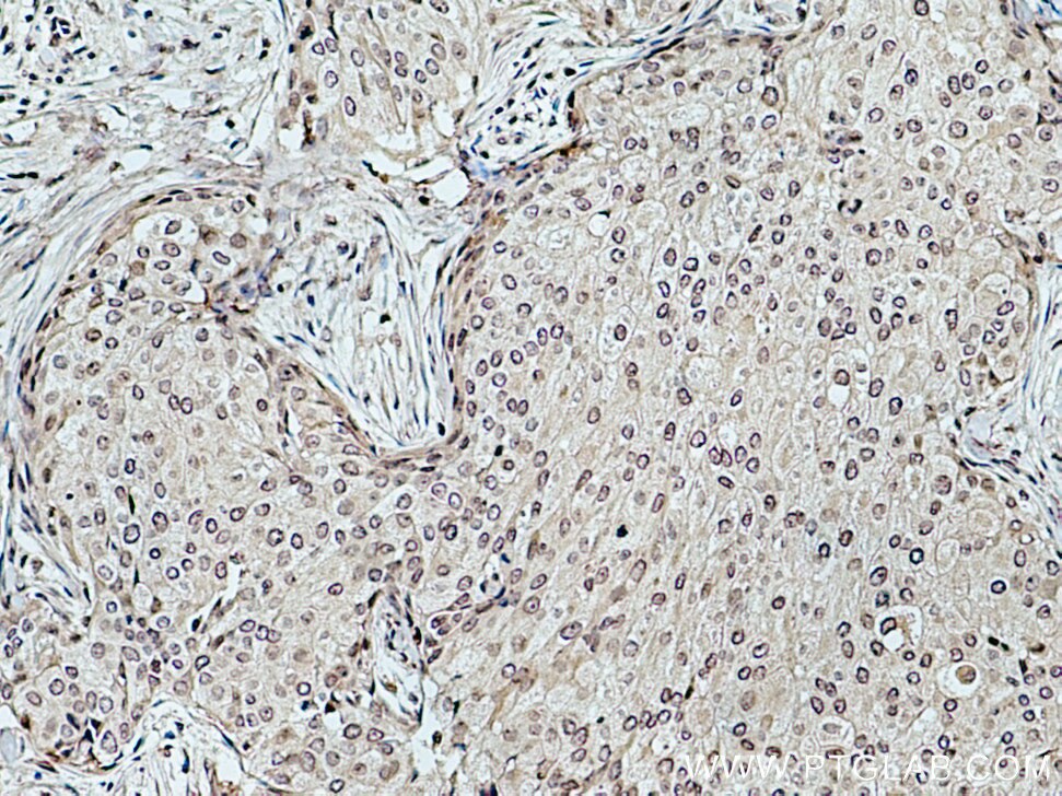 Immunohistochemistry (IHC) staining of human breast cancer tissue using DCPS Monoclonal antibody (67311-1-Ig)