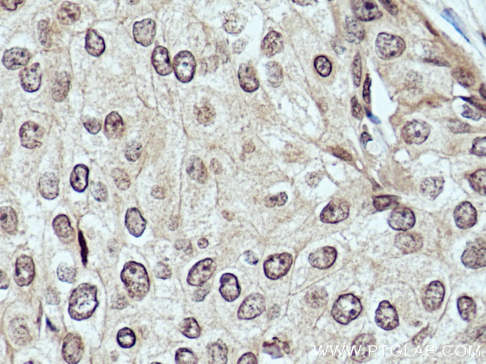 Immunohistochemistry (IHC) staining of human breast cancer tissue using DCPS Monoclonal antibody (67311-1-Ig)
