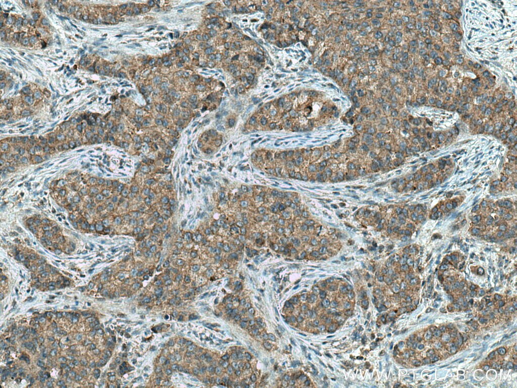 Immunohistochemistry (IHC) staining of human breast cancer tissue using DCTN5 Polyclonal antibody (10182-1-AP)