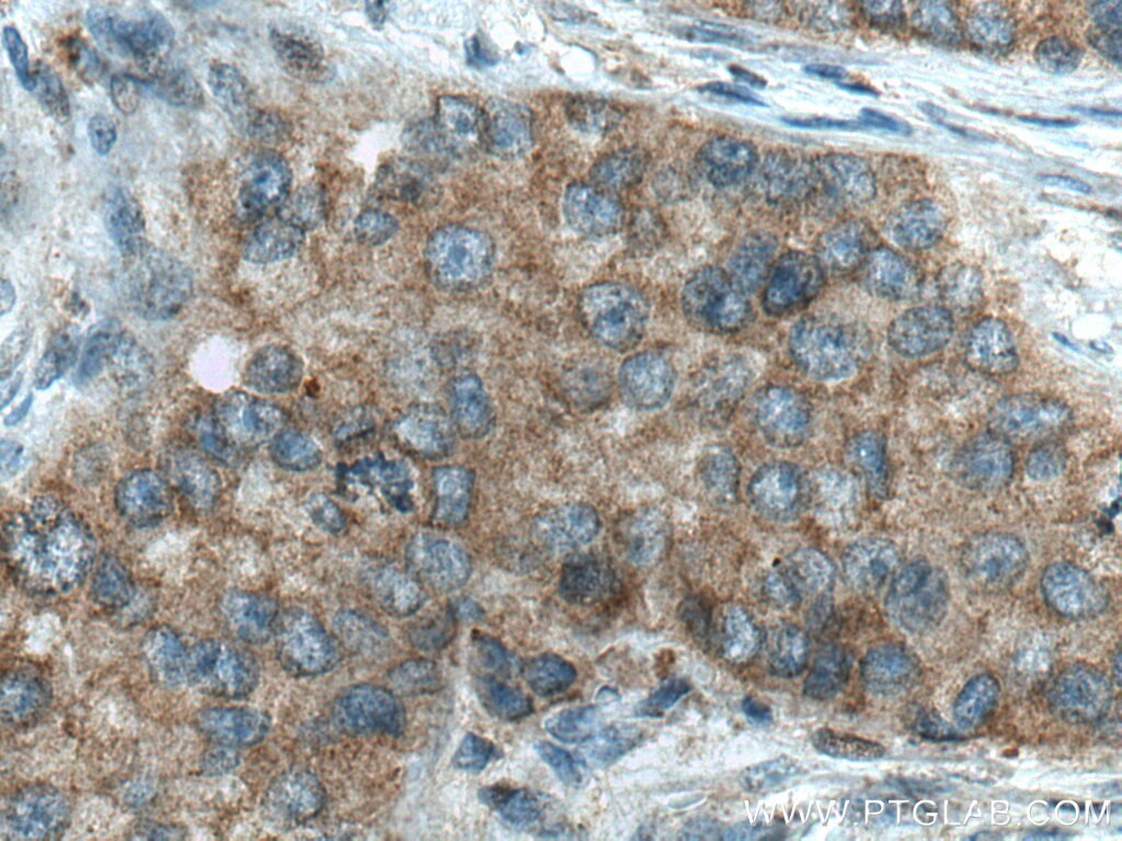 Immunohistochemistry (IHC) staining of human breast cancer tissue using DCTN5 Polyclonal antibody (10182-1-AP)