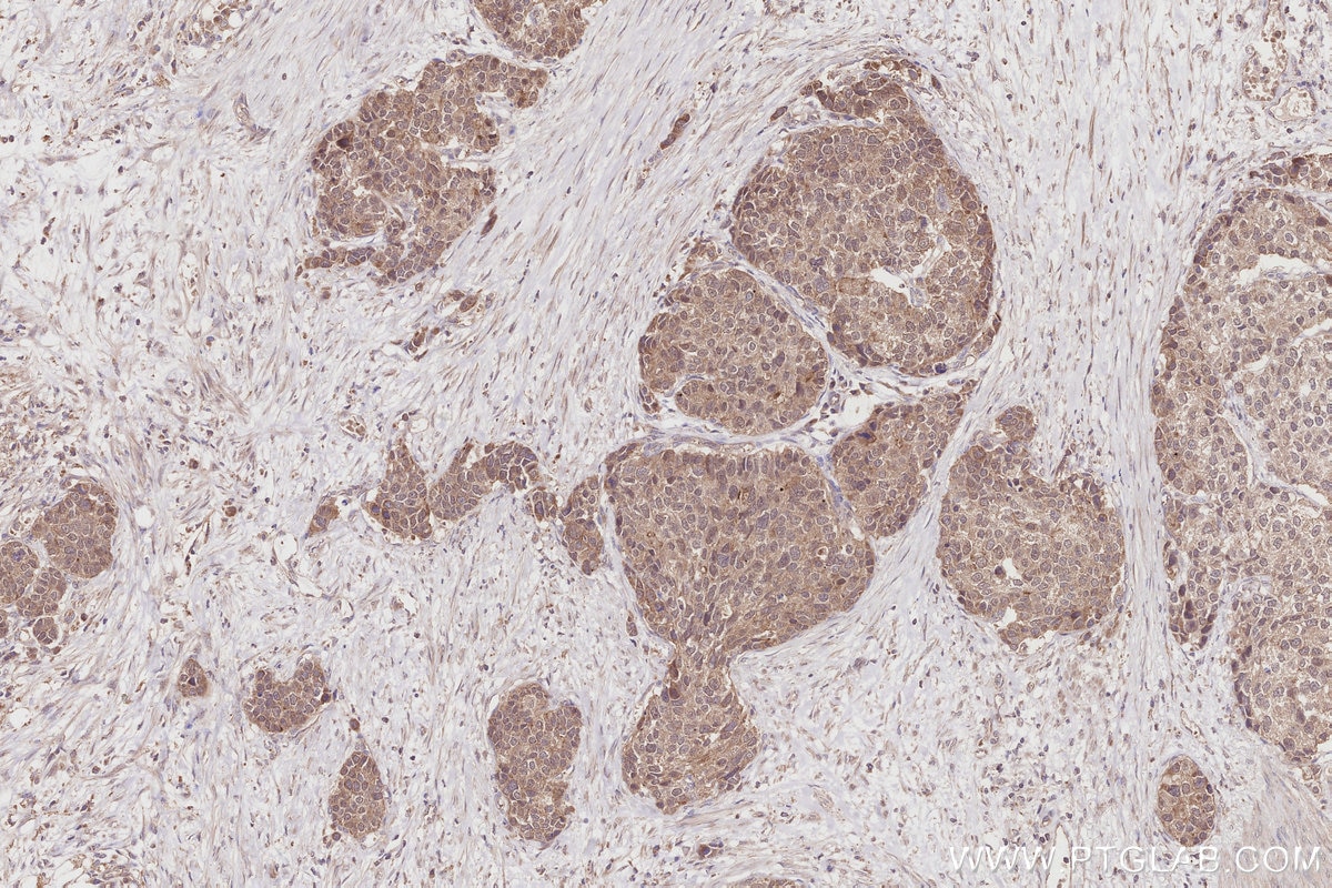 Immunohistochemistry (IHC) staining of human stomach cancer tissue using DCTN5 Polyclonal antibody (10182-1-AP)