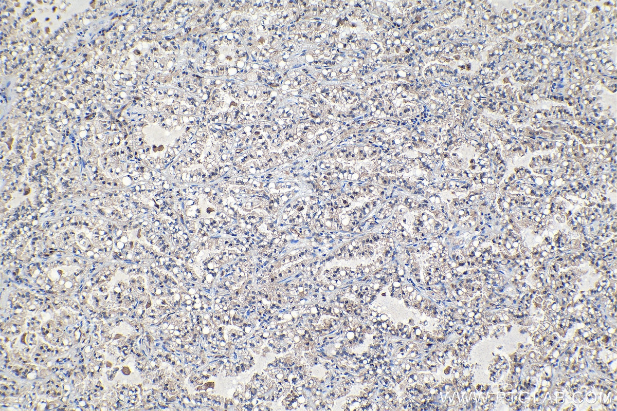 Immunohistochemistry (IHC) staining of human lung cancer tissue using DCTPP1 Polyclonal antibody (16684-1-AP)