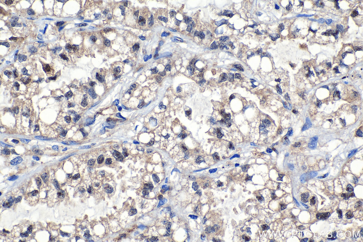 Immunohistochemistry (IHC) staining of human lung cancer tissue using DCTPP1 Polyclonal antibody (16684-1-AP)