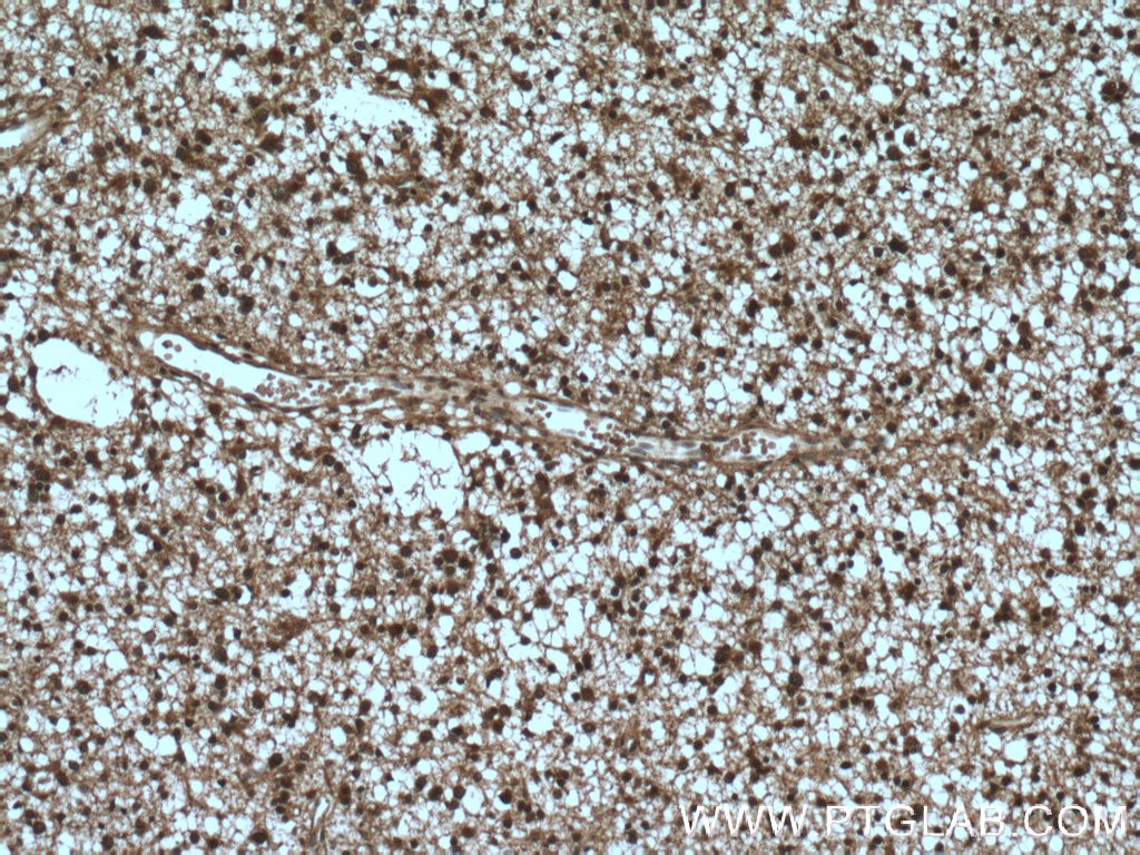 IHC staining of human gliomas using 10965-1-AP